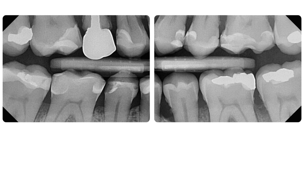 EzRay Air Wall™ - Apex-Dental