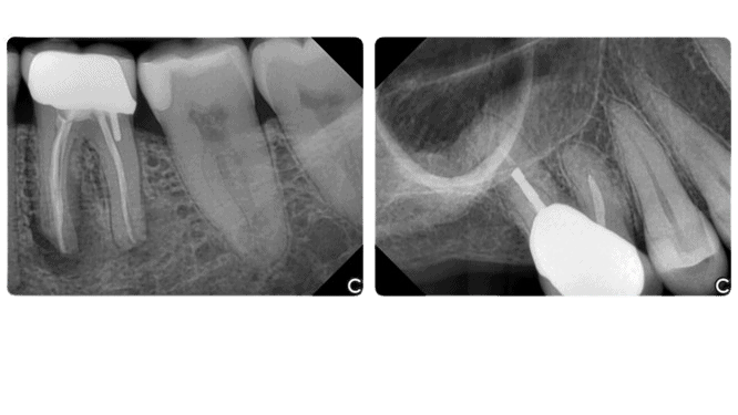 EzSensor™ Classic - Apex-Dental