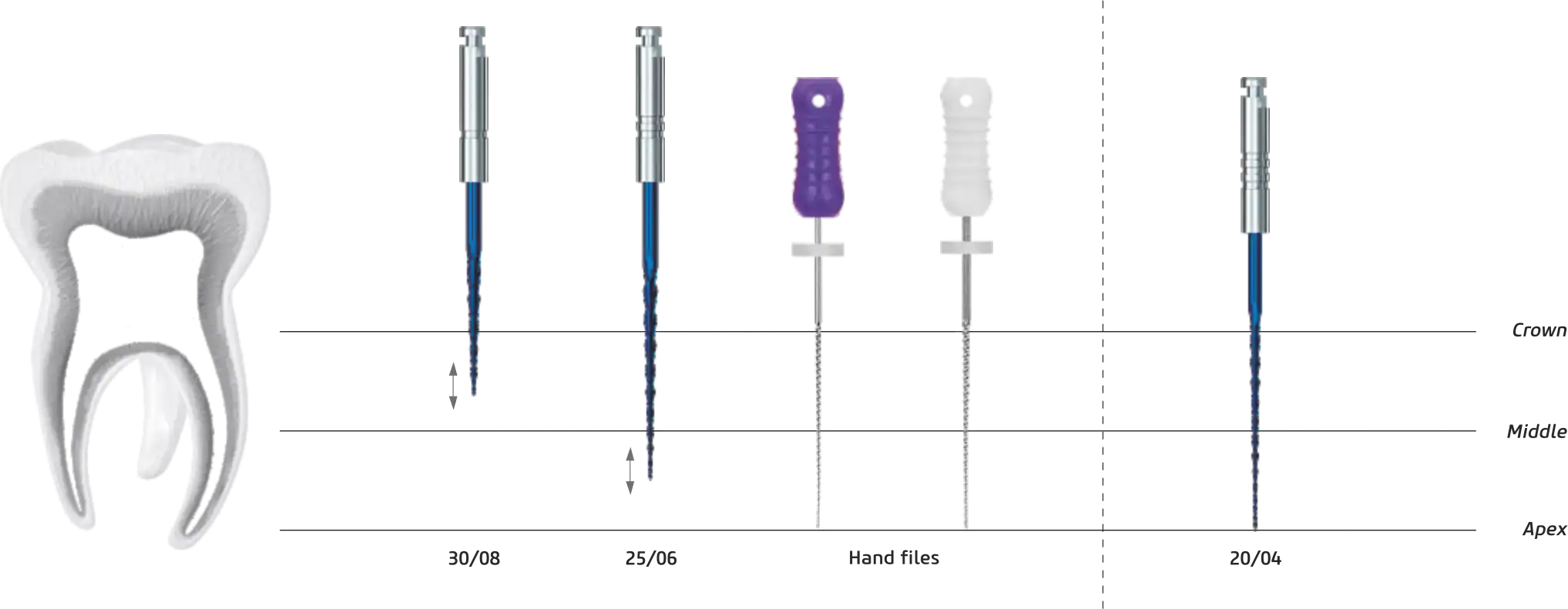 Endostar REvision egyszerű, lépésről lépésre követhető sorrend